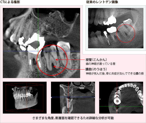 歯科用CTとレントゲンで撮影した画像の比較