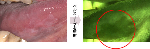 ベルスコープを照射した口腔内